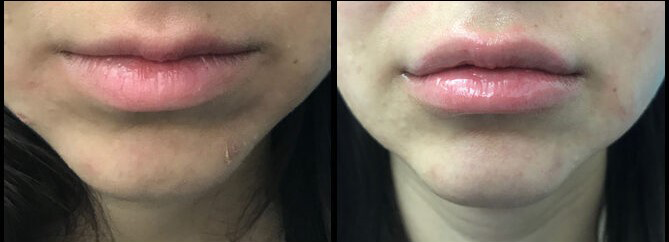 Non Invasive Cosmetics NYC | Call 646-470-0918 | Barry M Weintraub, MD, FACS