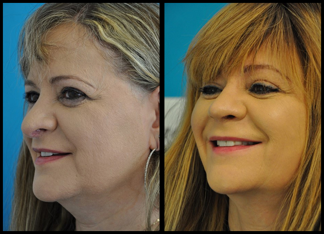 Before and After