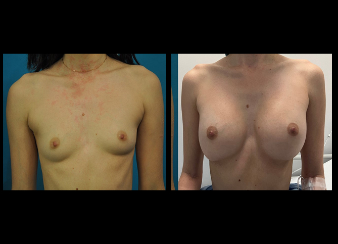 Before and After