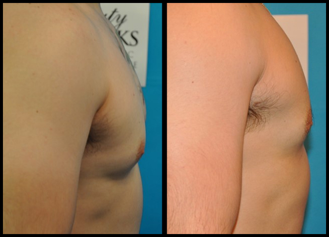 Before and After
