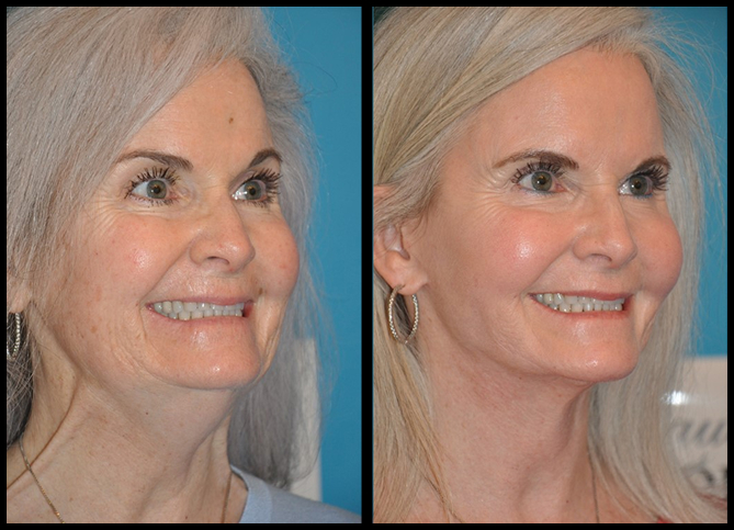 Before and After