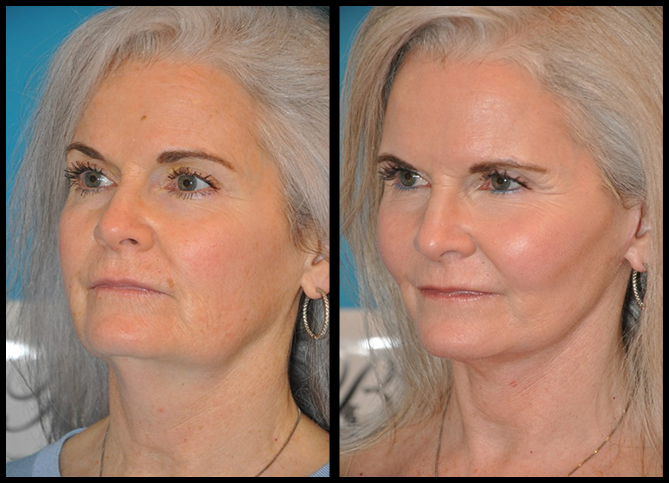 Before and After