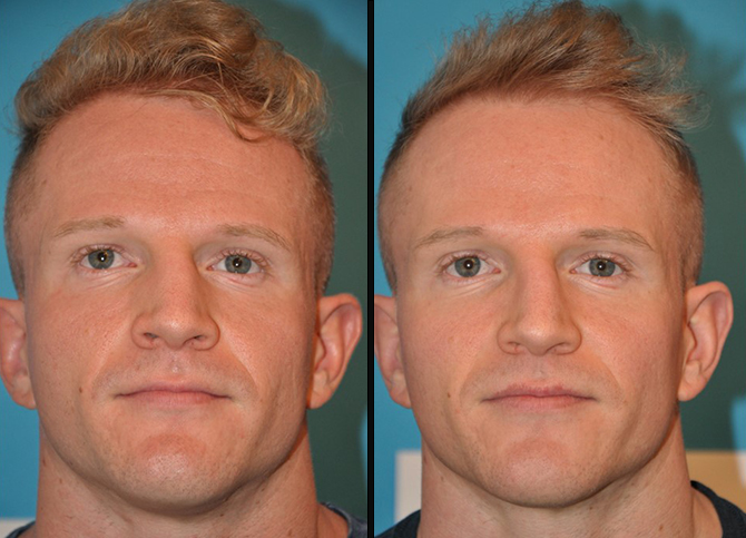 Before and After
