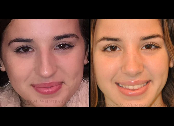 Before and After