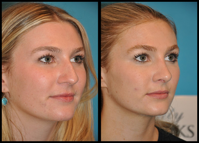 Before and After