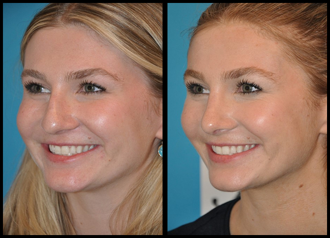 Before and After