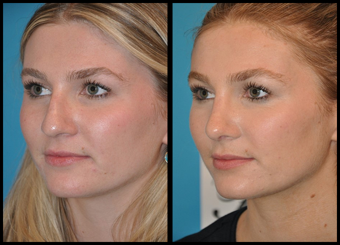 Before and After