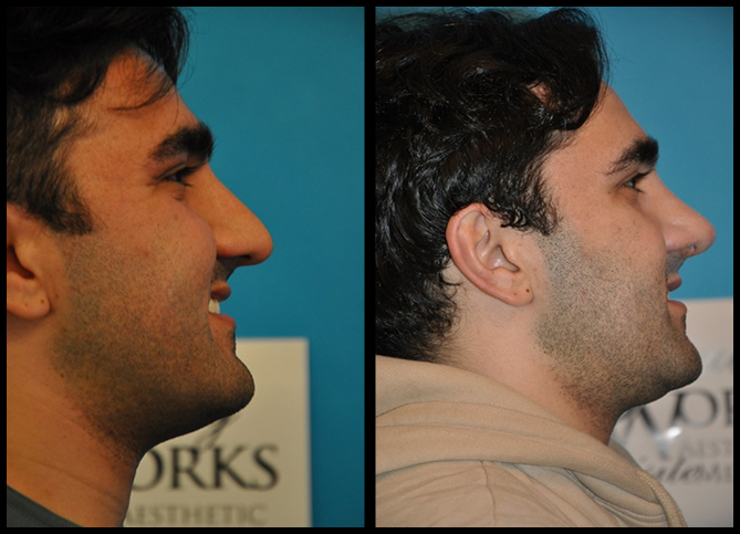 Before and After