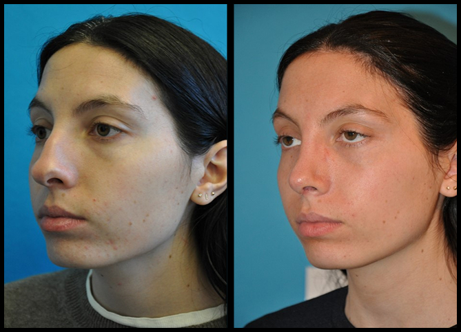 Before and After
