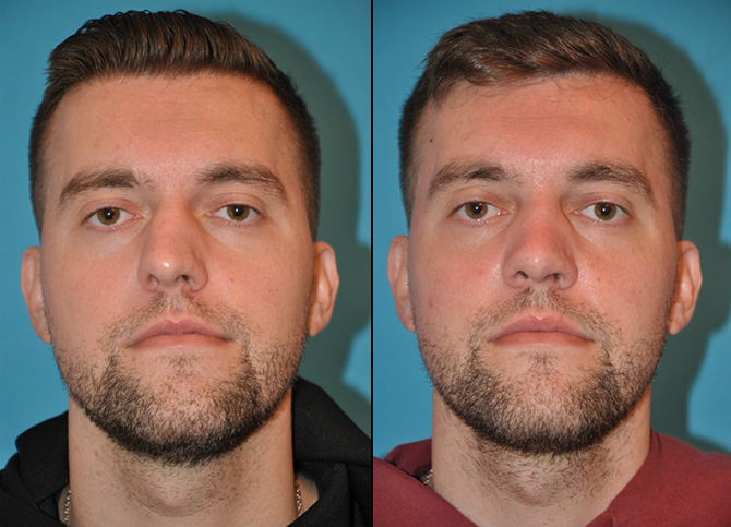 Before and After