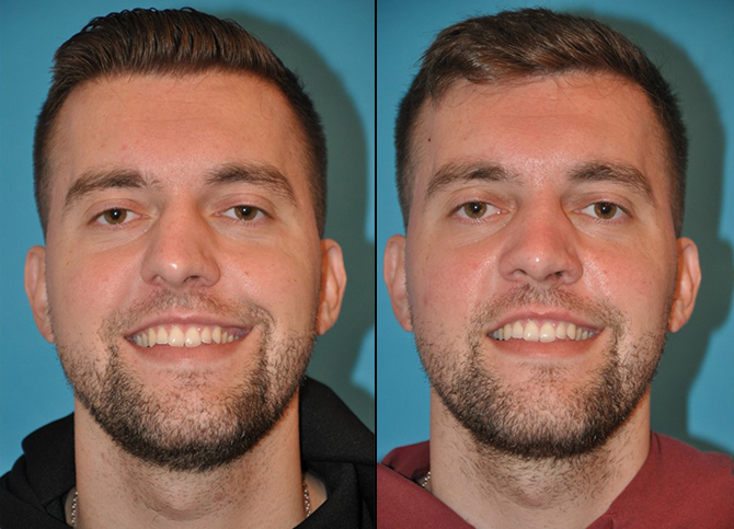 Before and After