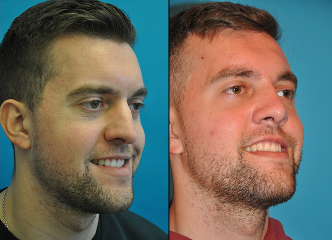 Before and After