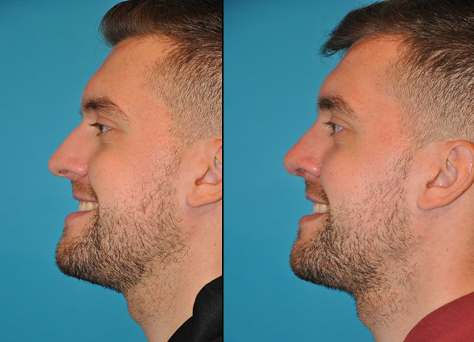 Before and After